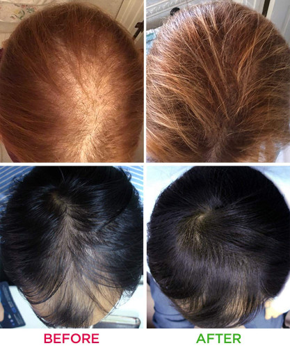 iRestore Laser Hair Growth System - FDA Cleared for Men and Women image 4