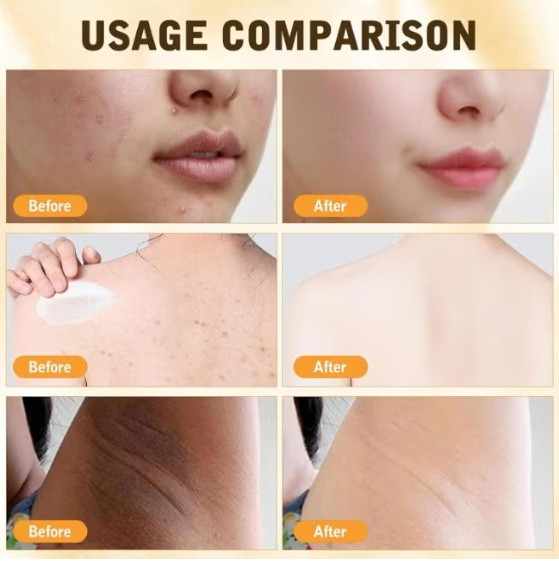 2PK SOUTH MOON bee venom ointment cream for skintags, warts & moles - 60G each image 2